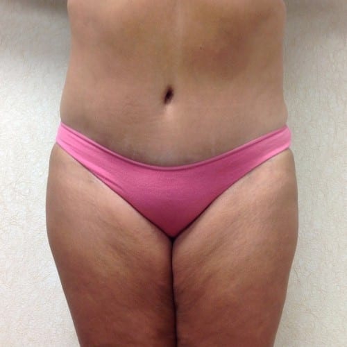 Abdominoplasty-01 | After Abdominoplasty