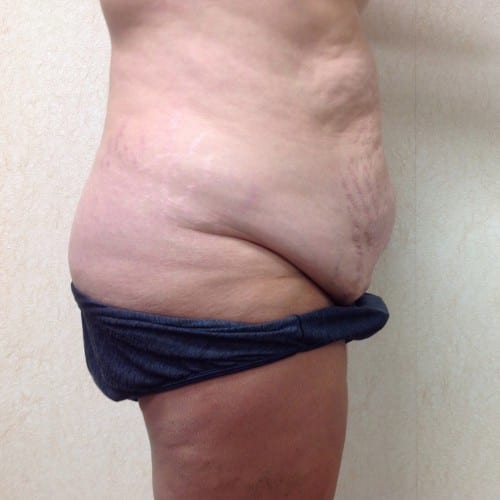 Abdominoplasty-01 | Before Abdominoplasty