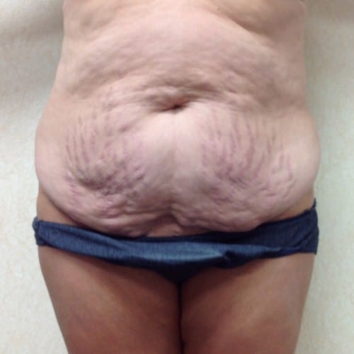 Abdominoplasty-01 | Before Abdominoplasty 2