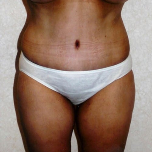 Abdominoplasty-02 | After Abdominoplasty 2