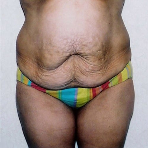 Abdominoplasty-02 | Before Abdominoplasty 2