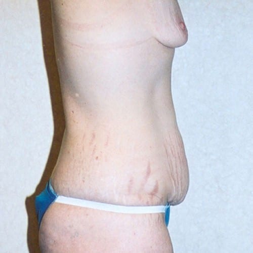 Abdominoplasty-03 | Before Abdominoplasty