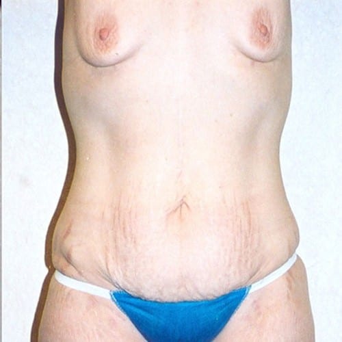 Abdominoplasty-03 | Before Abdominoplasty 2