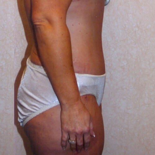 Abdominoplasty-04 | After Abdominoplasty