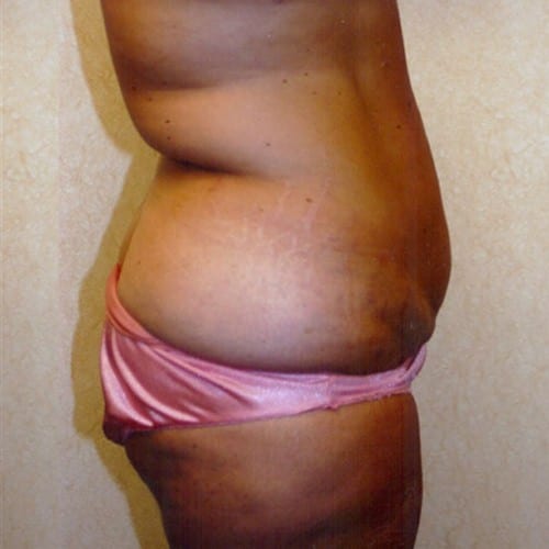 Abdominoplasty-04 | Before Abdominoplasty