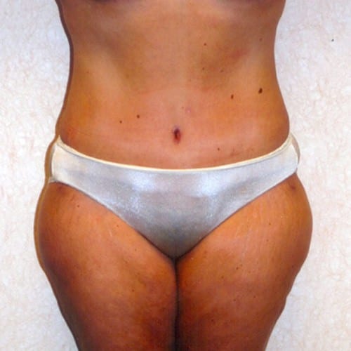 Abdominoplasty-04 | After Abdominoplasty 2