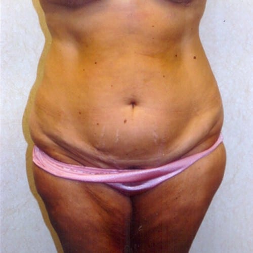 Abdominoplasty-04 | Before Abdominoplasty 2
