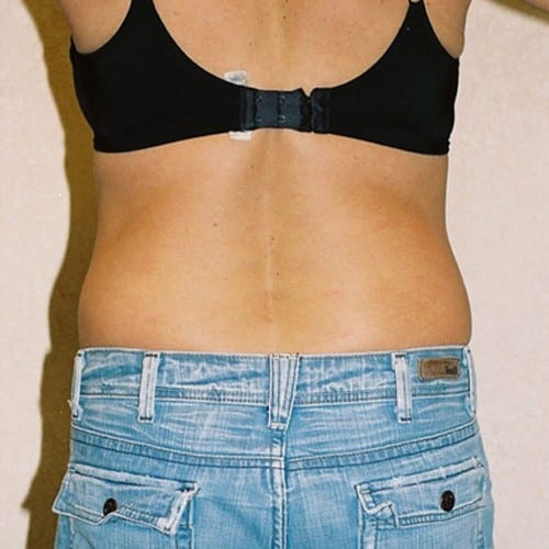 Abdominoplasty-05 | Before Abdominoplasty