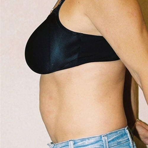 Abdominoplasty-05 | Before Abdominoplasty 3