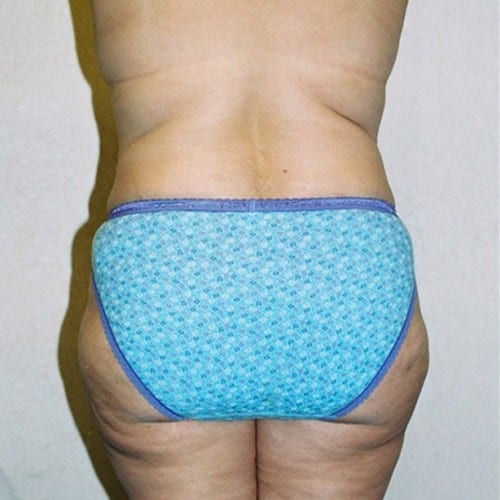 Abdominoplasty-06 | After Abdominoplasty