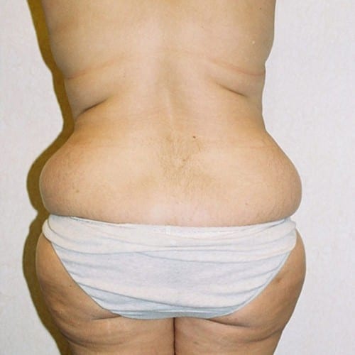 Abdominoplasty-06 | Before Abdominoplasty