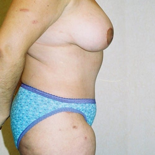 Abdominoplasty-06 | After Abdominoplasty 3