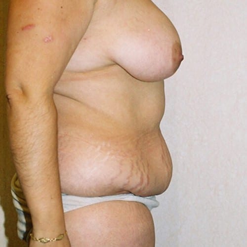 Abdominoplasty-06 | Before Abdominoplasty 3