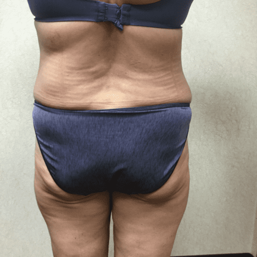 Abdominoplasty-07 | After Abdominoplasty