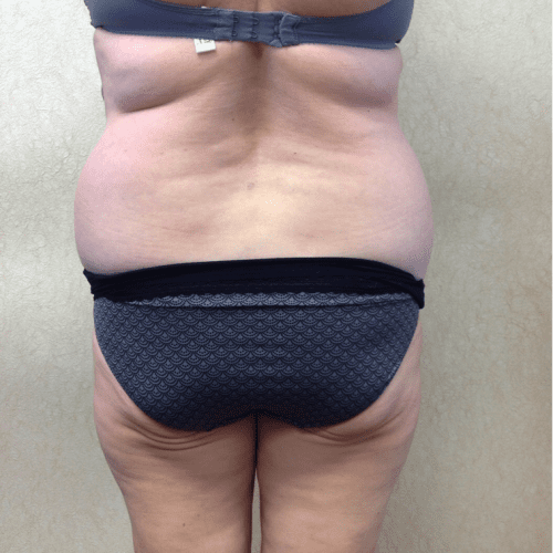 Abdominoplasty-07 | Before Abdominoplasty