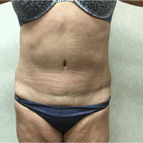 Abdominoplasty-07 | After Abdominoplasty 2