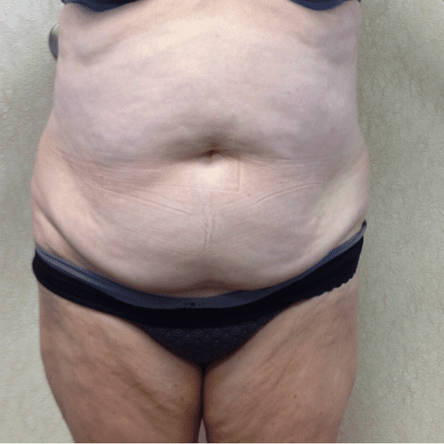 Abdominoplasty-07 | Before Abdominoplasty 2