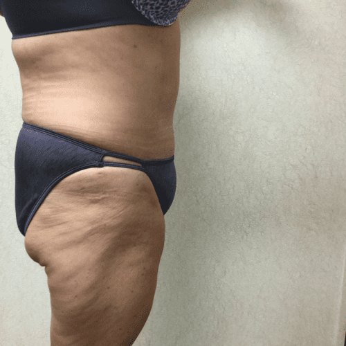 Abdominoplasty-07 | After Abdominoplasty 3