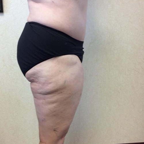 Abdominoplasty-08 | After Abdominoplasty