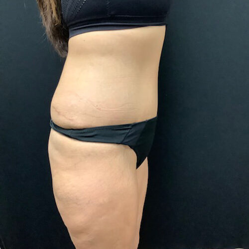 Abdominoplasty-09 | After Abdominoplasty