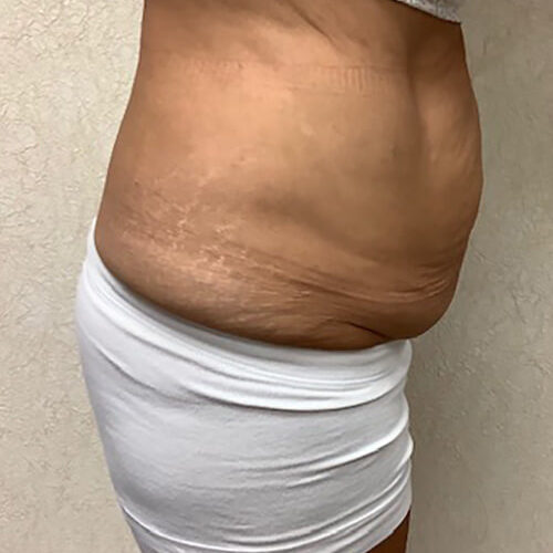 Abdominoplasty-09 | Before Abdominoplasty