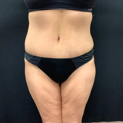 Abdominoplasty-09 | After Abdominoplasty 2