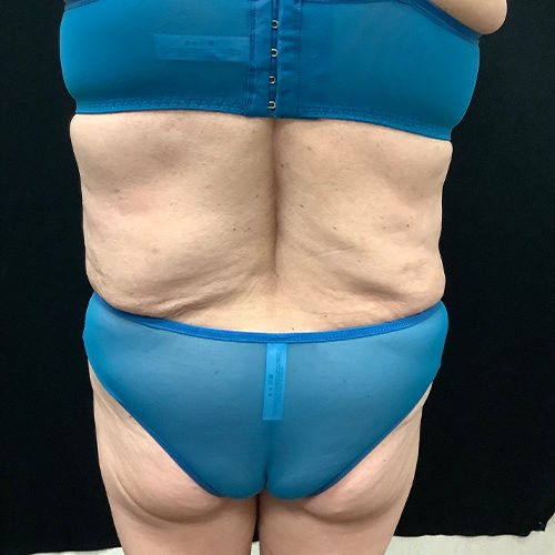 Abdominoplasty-10 | After Abdominoplasty