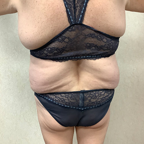 Abdominoplasty-10 | Before Abdominoplasty