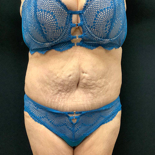 Abdominoplasty-10 | After Abdominoplasty 2