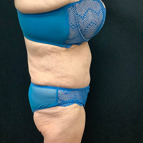 Abdominoplasty-10 | After Abdominoplasty 3