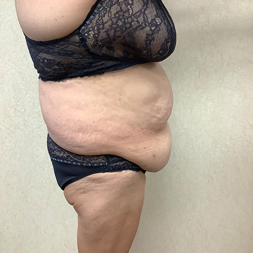 Abdominoplasty-10 | Before Abdominoplasty 3