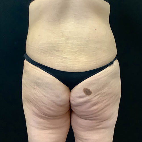 Abdominoplasty-11 | After Abdominoplasty