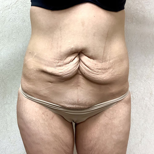 Abdominoplasty-11 | Before Abdominoplasty 2