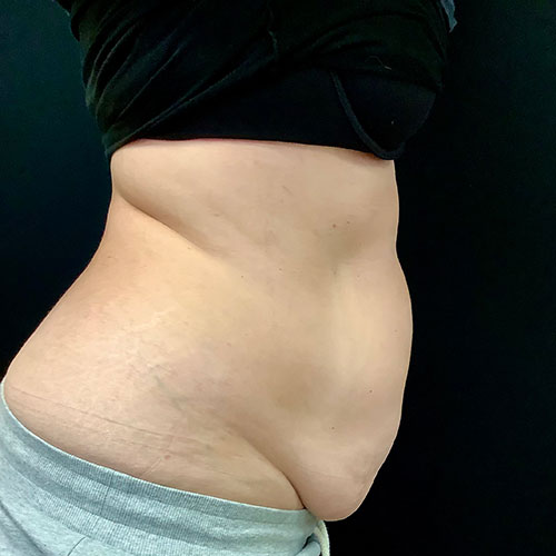 Abdominoplasty-12 | Before Abdominoplasty