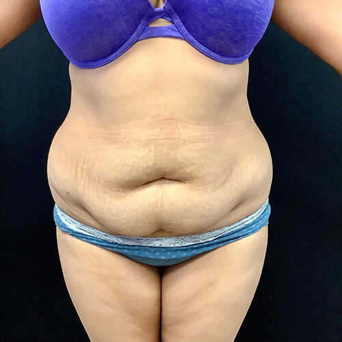 Abdominoplasty-13 | Before Abdominoplasty 2