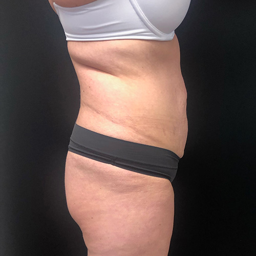 Abdominoplasty-14 | Before Abdominoplasty