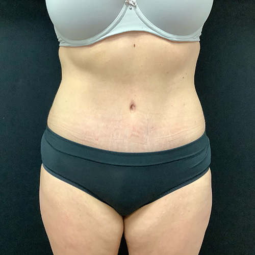 Abdominoplasty-14 | After Abdominoplasty 2