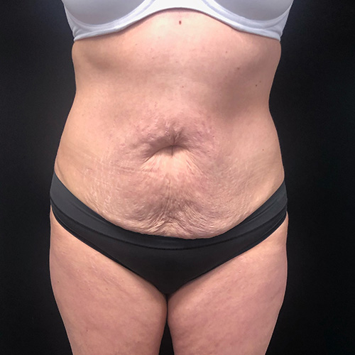 Abdominoplasty-14 | Before Abdominoplasty 2