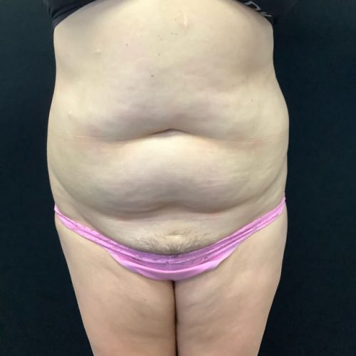 Abdominoplasty-15 | Before Abdominoplasty 2