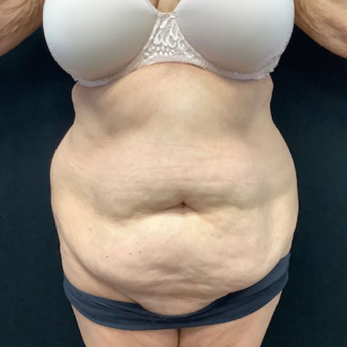 Abdominoplasty-16 | Before Abdominoplasty 2
