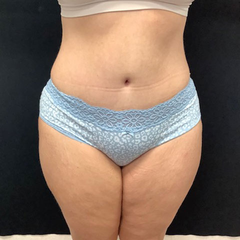 abdominoplasty 18 after