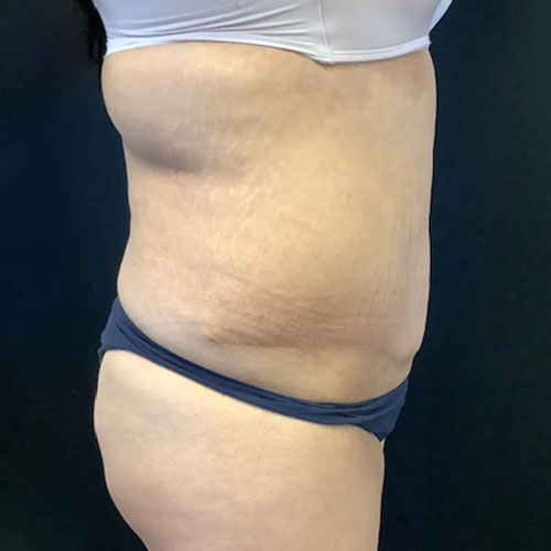 Abdominoplasty-19 | After Abdominoplasty