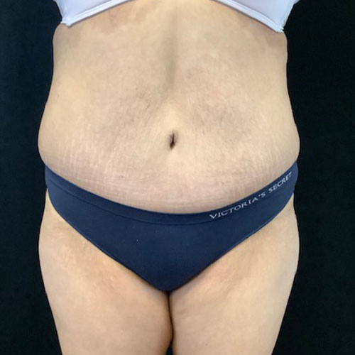 Abdominoplasty-19 | After Abdominoplasty 2