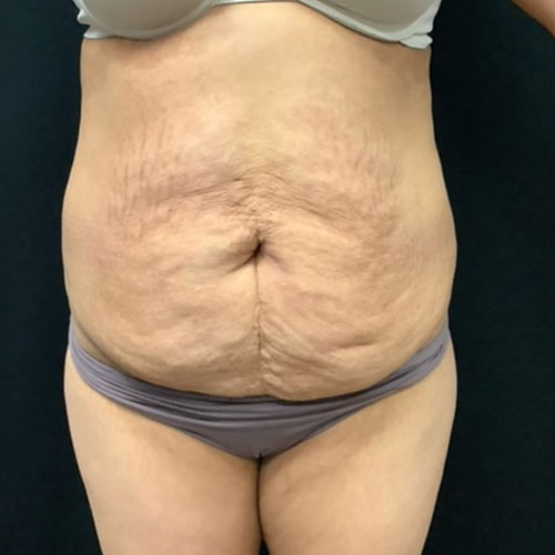 Abdominoplasty-19 | Before Abdominoplasty 2