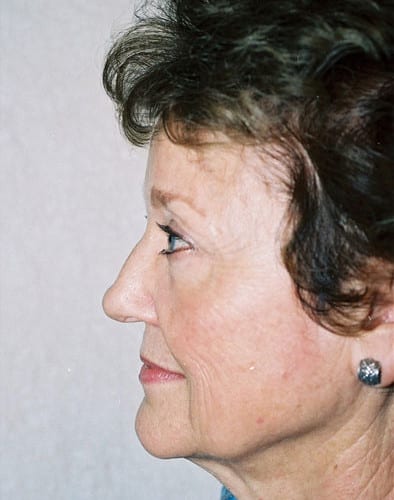 Blepharoplasty-01 | After Blepharoplasty 2