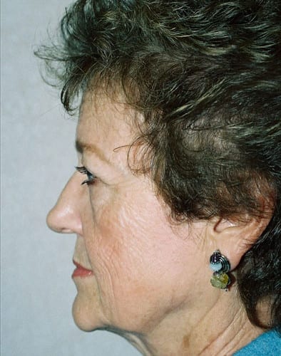 Blepharoplasty-01 | Before Blepharoplasty 2