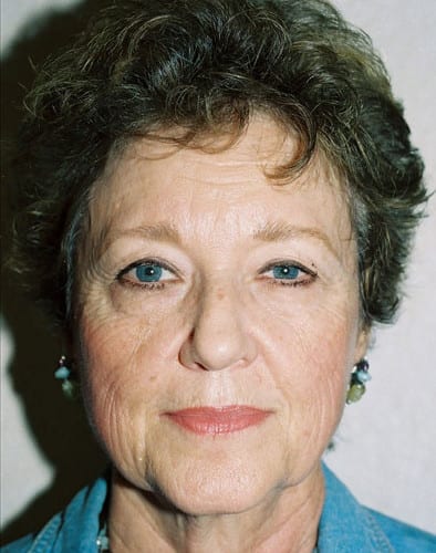 Blepharoplasty-01 | Before Blepharoplasty