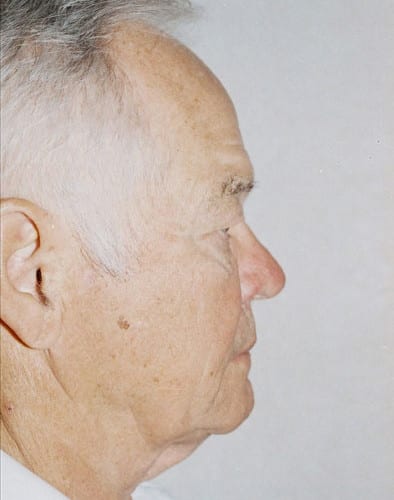 Blepharoplasty-02 | Before Blepharoplasty 2