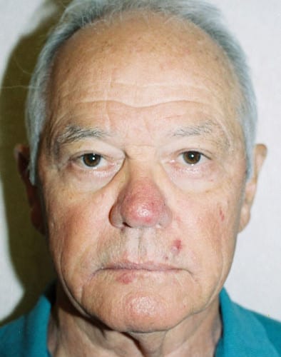 Blepharoplasty-02 | After Blepharoplasty