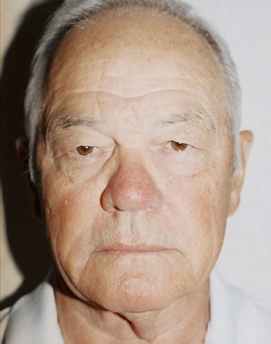 Blepharoplasty-02 | Before Blepharoplasty